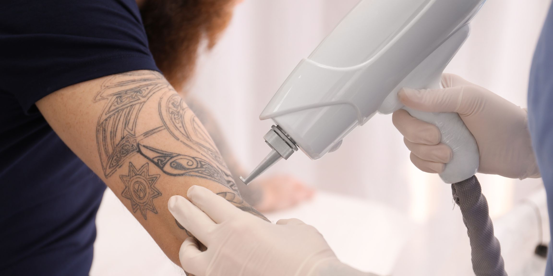 Laser Tattoo Removal Gold Coast | Professional Tattoo Removal Gold Coast