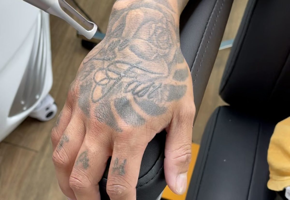 Laser Tattoo Removal Gold Coast Professional Tattoo Removal Gold Coast