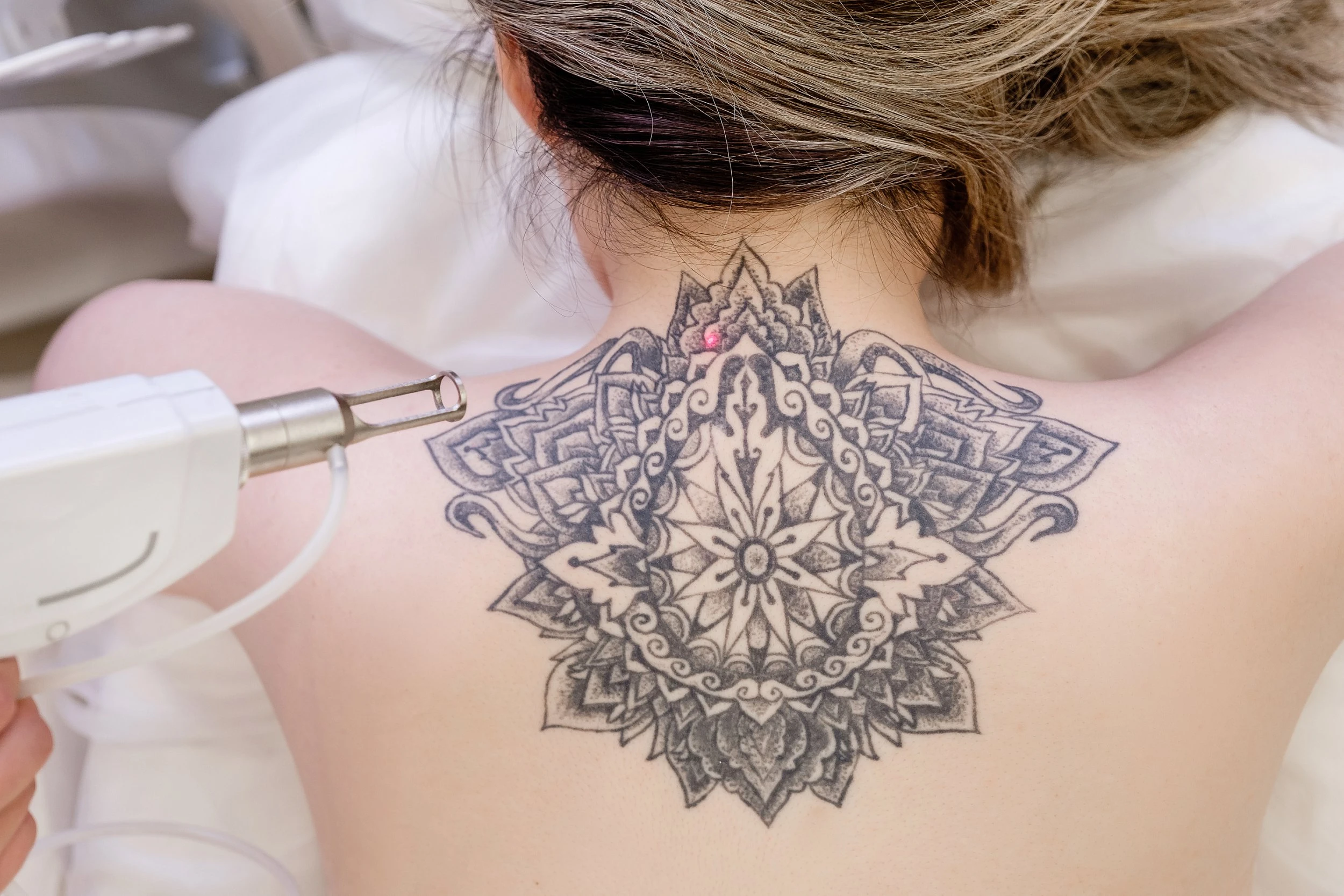 Laser Tattoo Removal Gold Coast | Professional Tattoo Removal Gold Coast